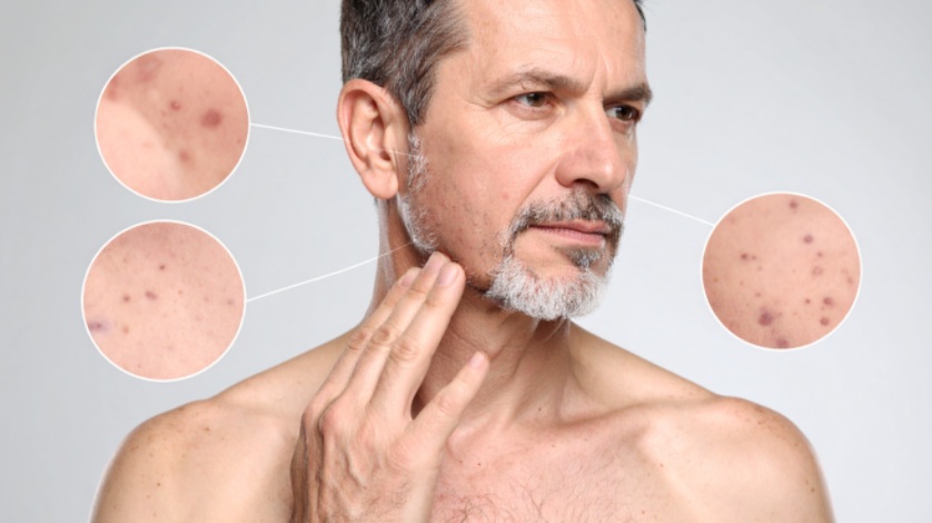 Avanços no tratamento do melasma e distúrbios de pigmentação